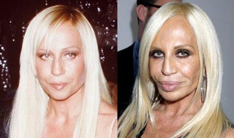 Plastic-Surgery-Blunders-In-Hollywood-3-Fashion-And-Beauty-Lifestyle-DKODING
